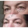 wm_double_eyelid_L07.jpg